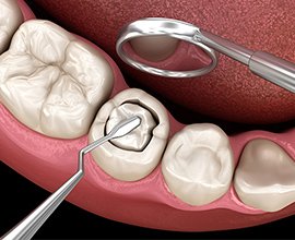 CR（コンポジットレジン） イメージ