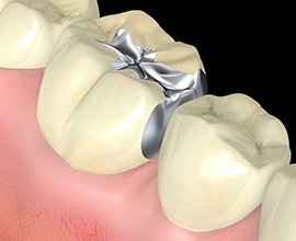 クラウン・インレー イメージ