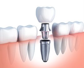 ブリッジ・入れ歯・インプラント イメージ