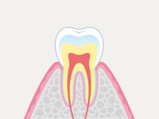 虫歯の進行度別にみる症状と治療 イメージ
