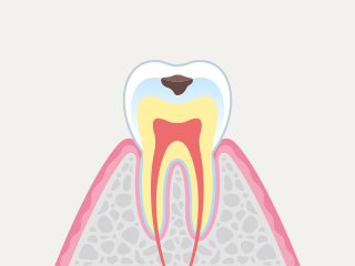 虫歯の進行度別にみる症状と治療 イメージ2