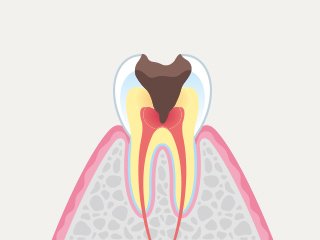 虫歯の進行度別にみる症状と治療 イメージ4
