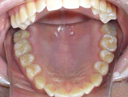 歯科金属アレルギー 症例写真