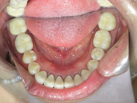 噛み合わせと審美的治療 症例写真