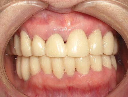 噛み合わせがズレたら 症例写真