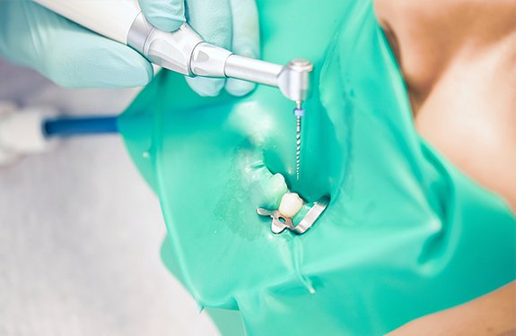 大切な歯を残すための精密な根管治療 イメージ