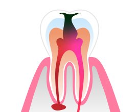 治療が必要となる主なケースと症状 イメージ1