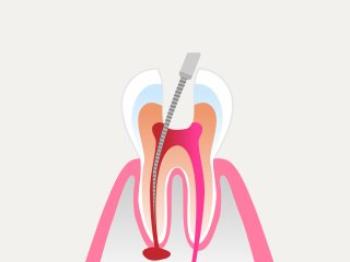 治療の流れ イメージ2