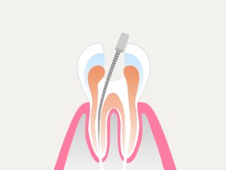 治療の流れ イメージ4