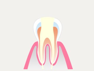 治療の流れ イメージ5