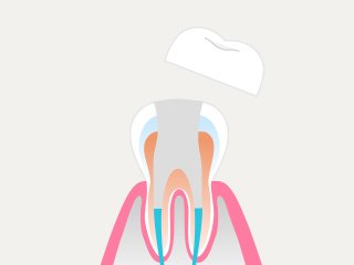 治療の流れ イメージ6