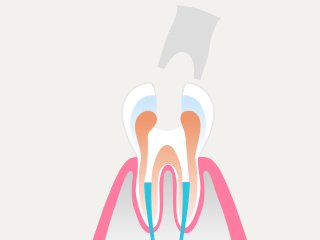 治療の流れ イメージ7