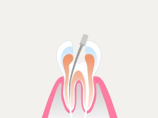 治療の流れ イメージ9