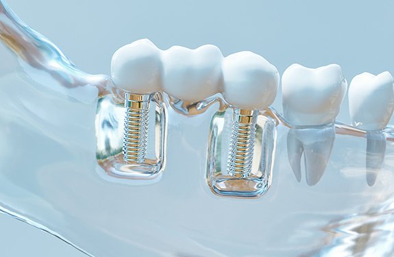 機能回復と口元のバランスに配慮したインプラント治療 イメージ