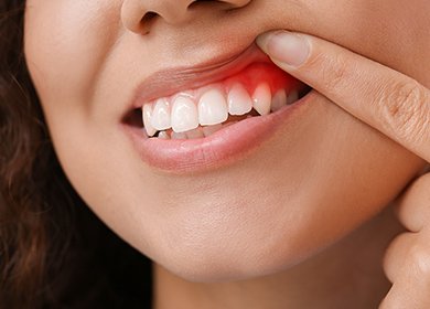 インプラント周囲炎 イメージ