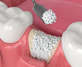 ボーングラフト（骨移植）の処置イメージ