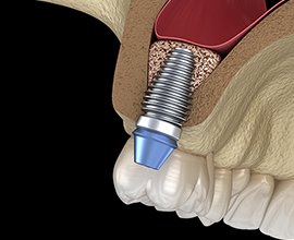 ソケットリフトの処置イメージ