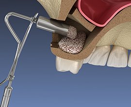 サイナスリフトの処置イメージ