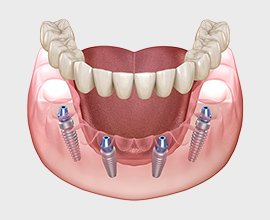 All-on-4による全顎インプラント治療のイメージ