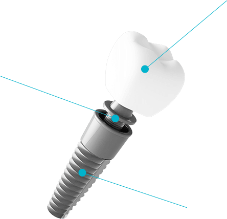 インプラントの構造図