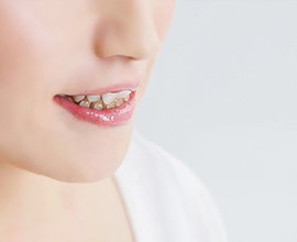 目立ちにくいクリアブラケット