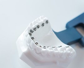 舌側矯正にも対応