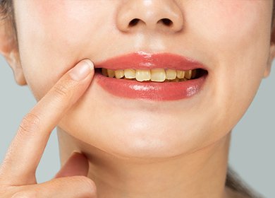 歯周病の原因 イメージ