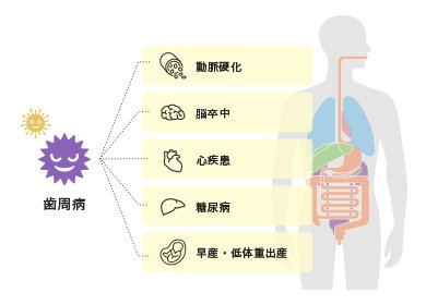 歯周病と全身疾患の関係 イメージ
