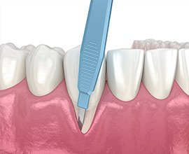 フラップ手術 イメージ