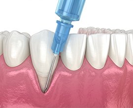 歯周組織再生療法 イメージ