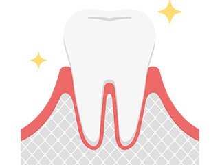 歯周病の進行と症状 イメージ1