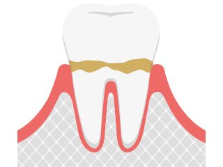 歯周病の進行と症状 イメージ2