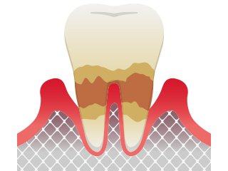 歯周病の進行と症状 イメージ4