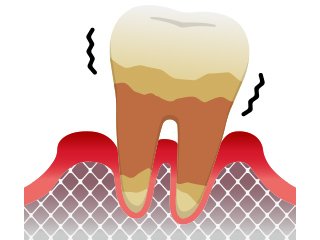 歯周病の進行と症状 イメージ5