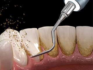 歯周病治療の流れ イメージ3