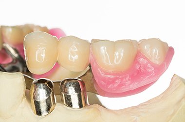 ダブル冠（当院独自の治療法）