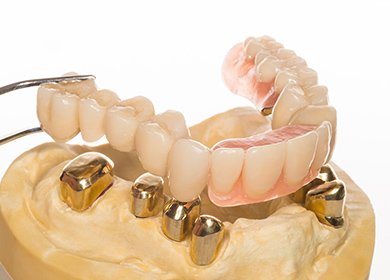 長期安定を見据えた咬合挙上治療 イメージ