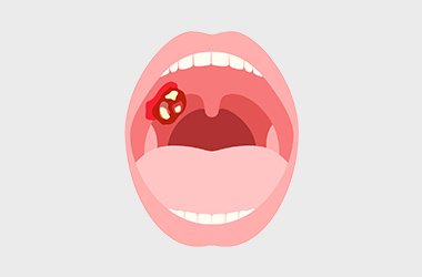 舌がん イメージ