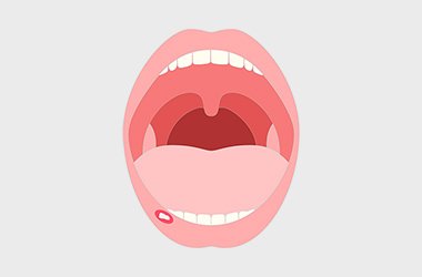 粘液嚢胞 イメージ