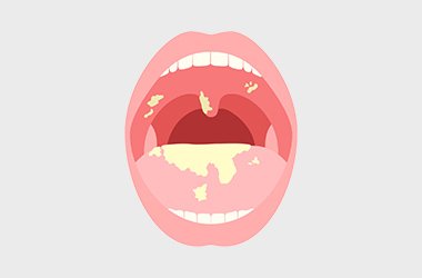 その他の口腔粘膜疾患 イメージ