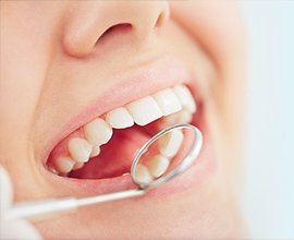 歯石・着色の除去