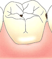 症状：自覚症状なし、まれに歯がしみる