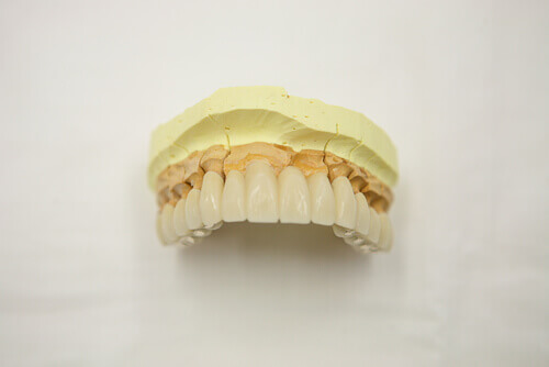 コーヌス義歯⑥