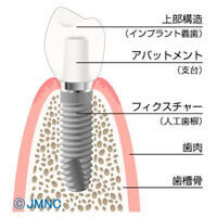 インプラント治療について