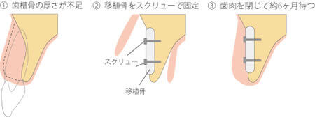 ベニアグラフト