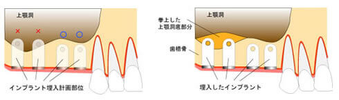 サイナスリフト