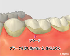 歯周病の原因