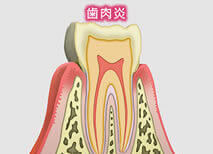 歯肉炎