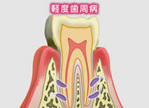 軽度歯周病