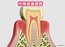 中等度歯周病